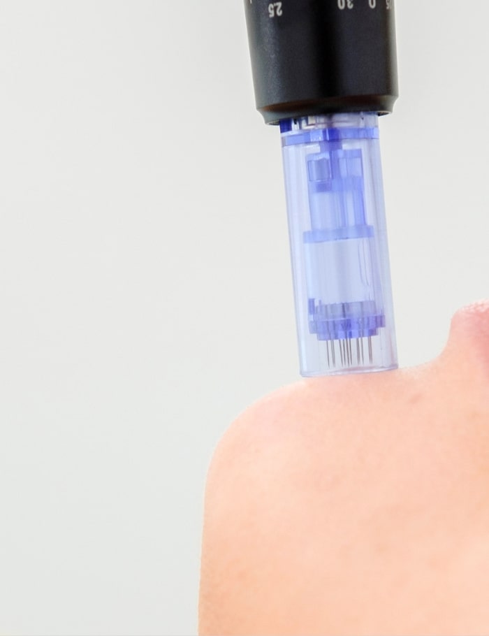 Dermaapen4 treatment at chin