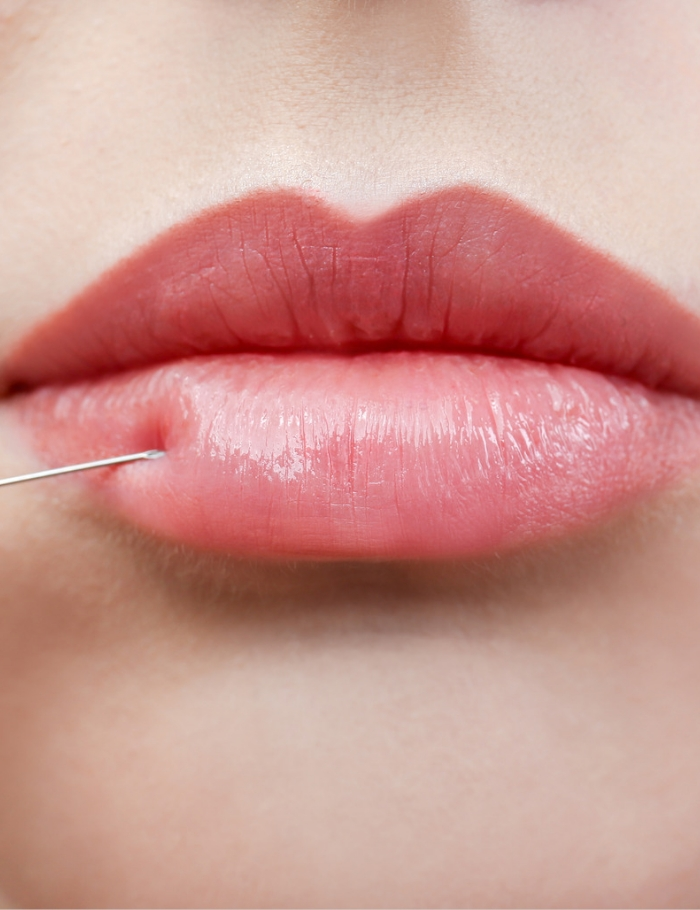 lip filler