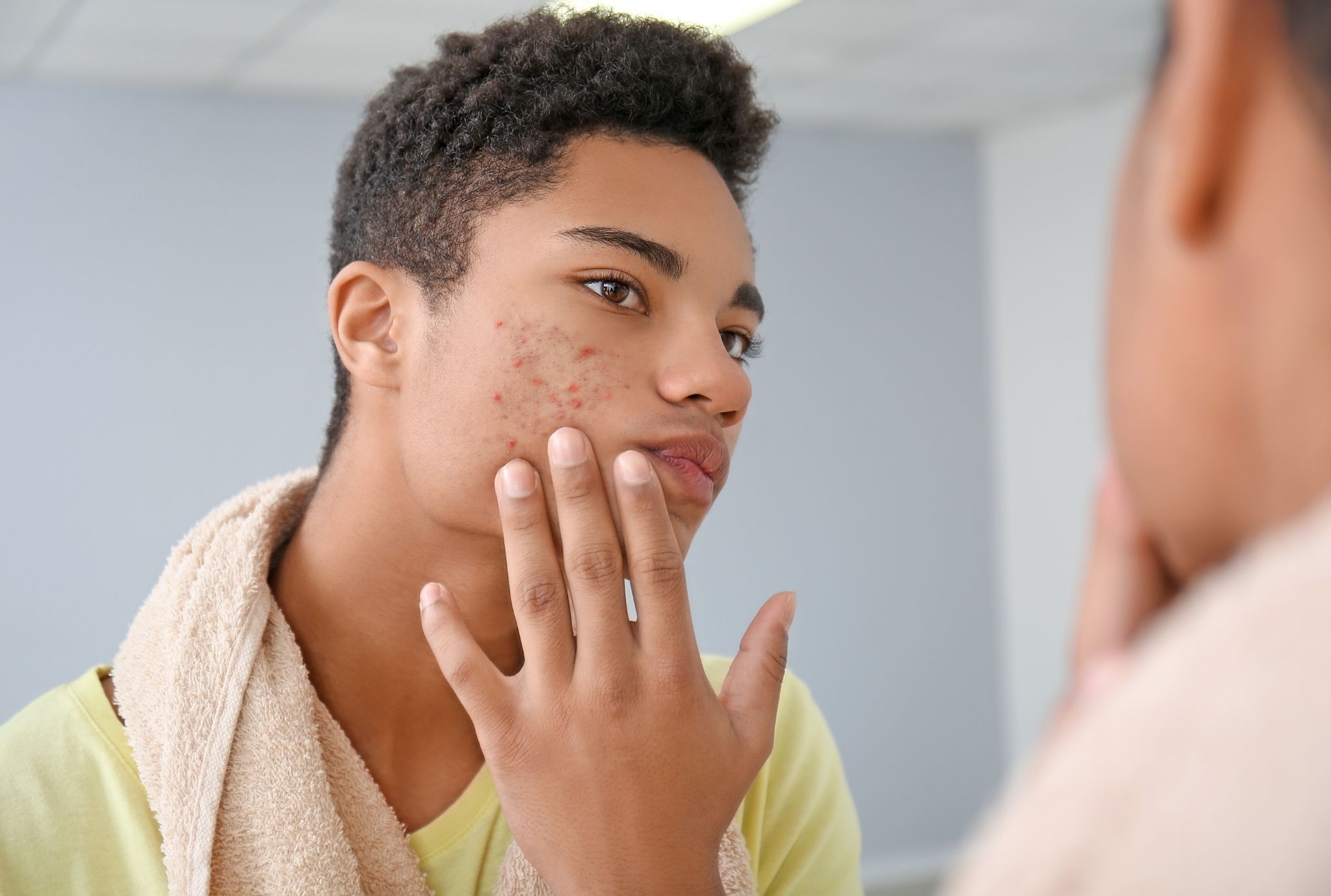 acne scar